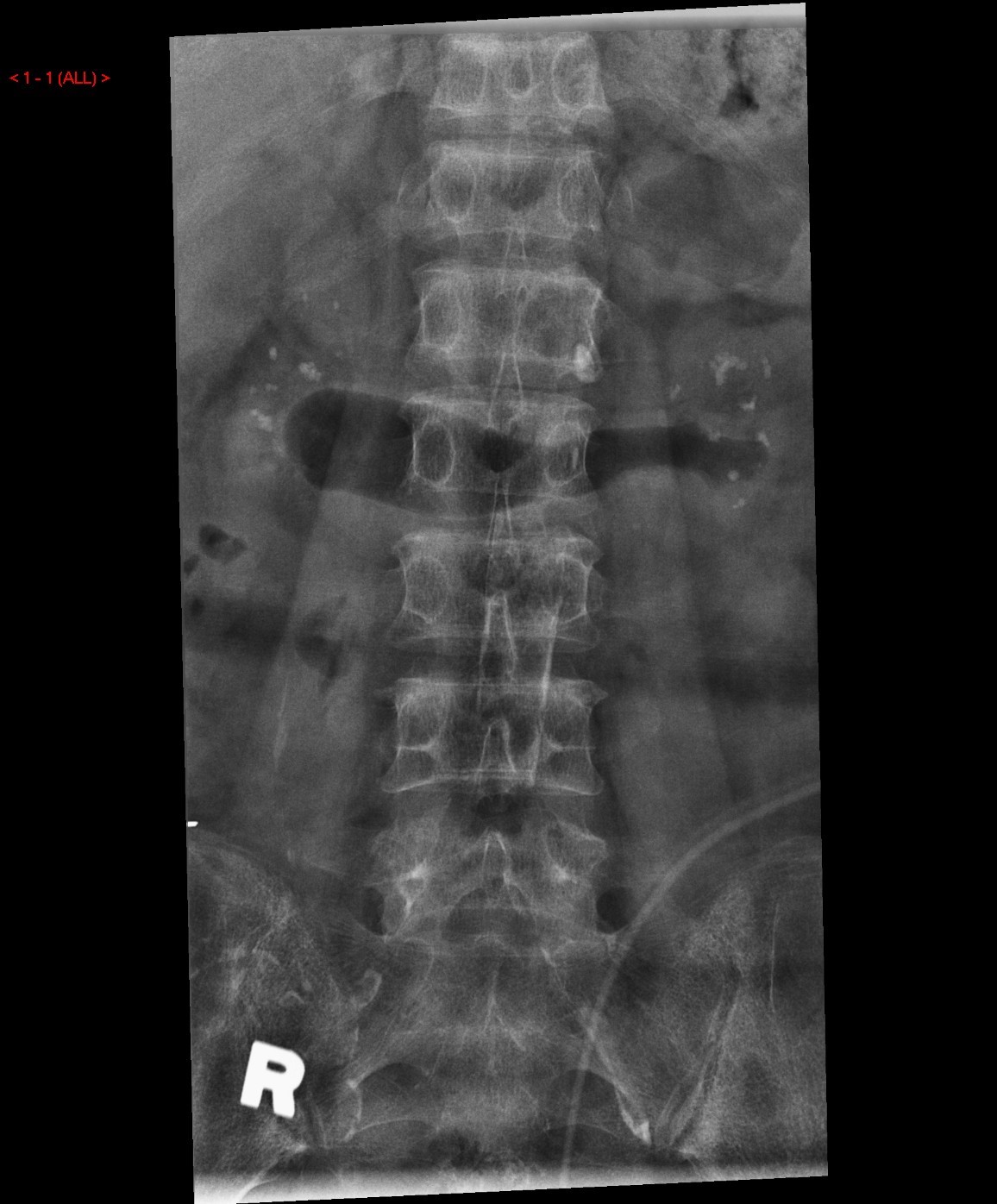 X Rays of lumbosacral spine 1
